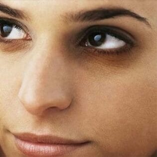 encyclopedia ما هو علاج الهالات السوداء