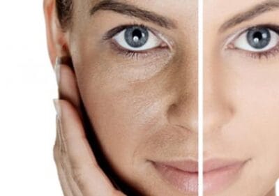 طريقة علاج كلف الوجه